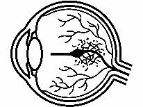 網膜静脈閉塞症